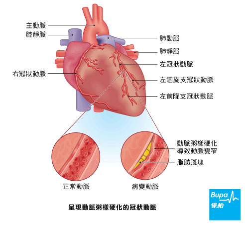 angina_atherosclerosis-chi