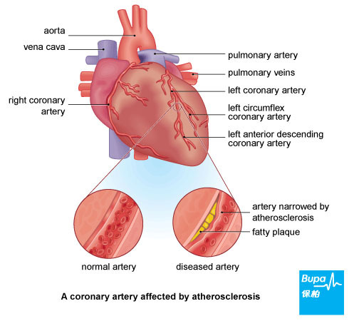 Angina_Atherosclerosis-Eng