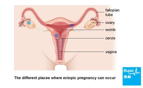 Image - Etcopic pregnancy-Eng